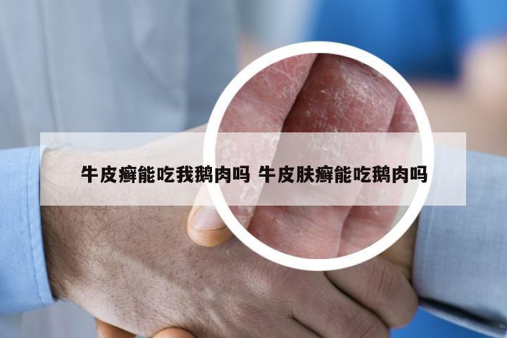 牛皮癣能吃我鹅肉吗 牛皮肤癣能吃鹅肉吗