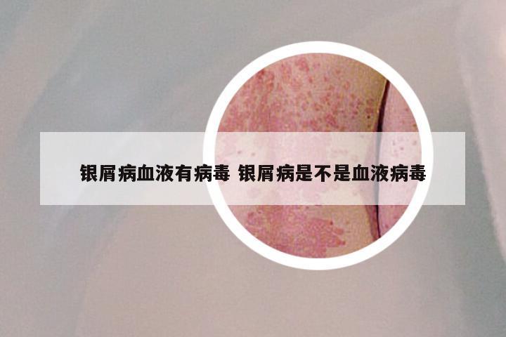 银屑病血液有病毒 银屑病是不是血液病毒