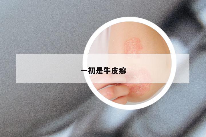 一初是牛皮癣