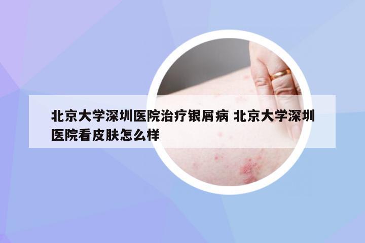 北京大学深圳医院治疗银屑病 北京大学深圳医院看皮肤怎么样