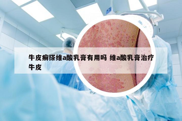 牛皮癣搽维a酸乳膏有用吗 维a酸乳膏治疗牛皮