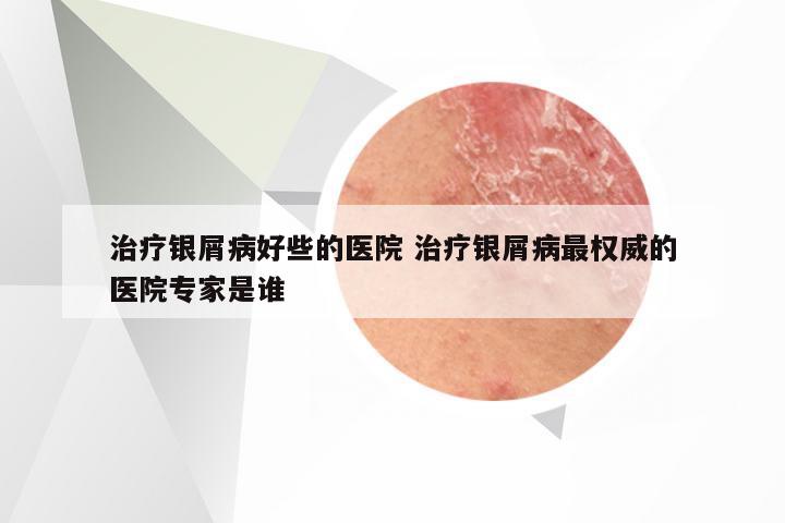 治疗银屑病好些的医院 治疗银屑病最权威的医院专家是谁