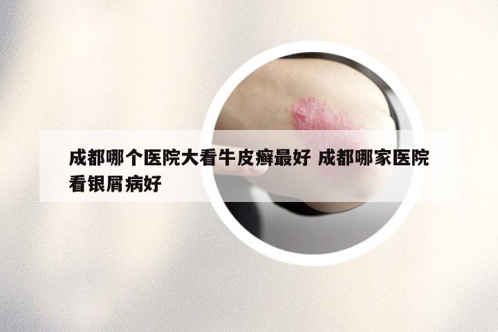成都哪个医院大看牛皮癣最好 成都哪家医院看银屑病好