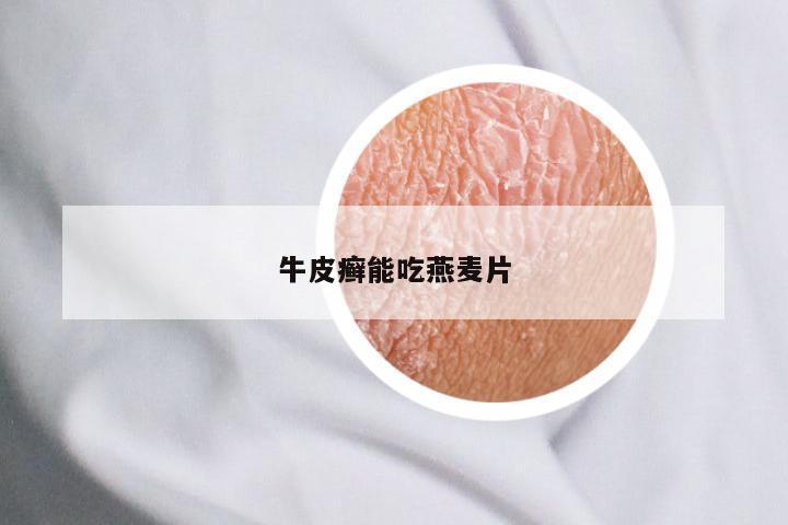 牛皮癣能吃燕麦片