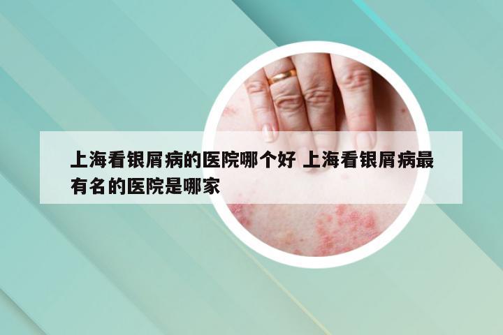 上海看银屑病的医院哪个好 上海看银屑病最有名的医院是哪家