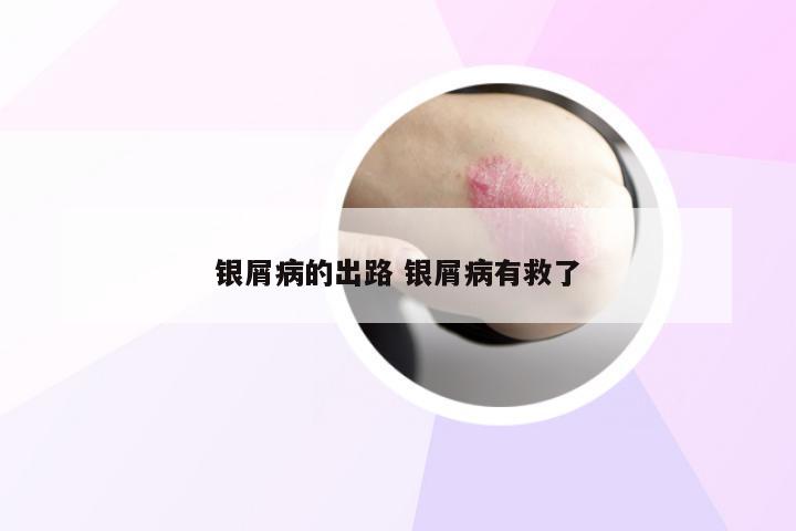 银屑病的出路 银屑病有救了