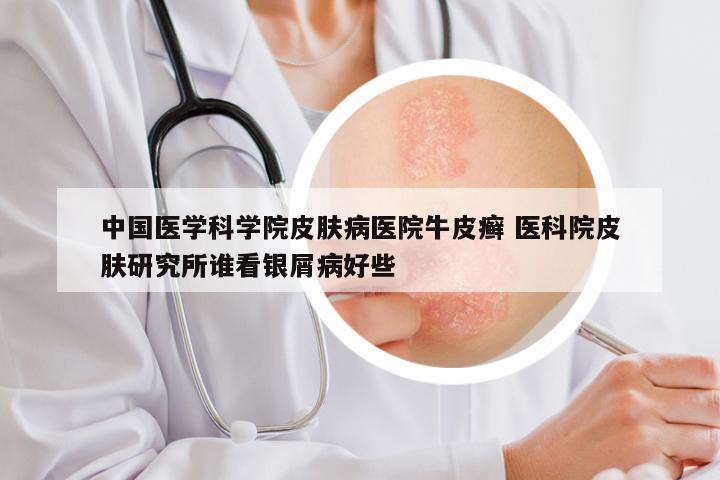 中国医学科学院皮肤病医院牛皮癣 医科院皮肤研究所谁看银屑病好些