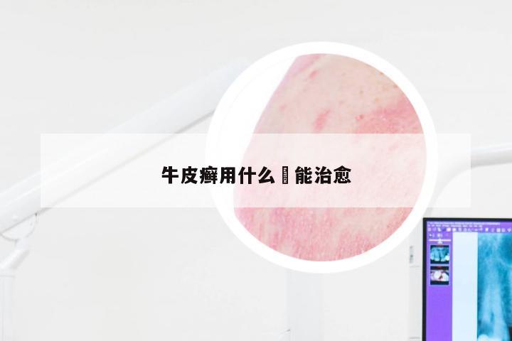 牛皮癣用什么芶能治愈