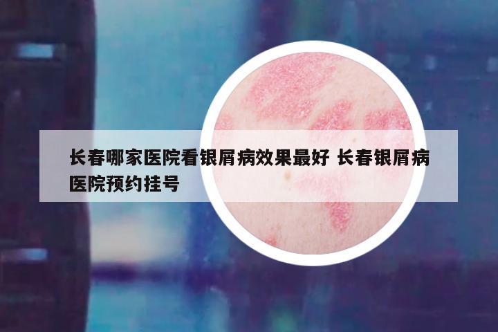 长春哪家医院看银屑病效果最好 长春银屑病医院预约挂号