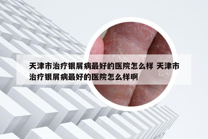 天津市治疗银屑病最好的医院怎么样 天津市治疗银屑病最好的医院怎么样啊