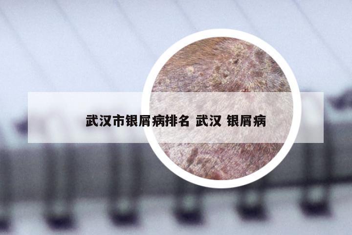 武汉市银屑病排名 武汉 银屑病