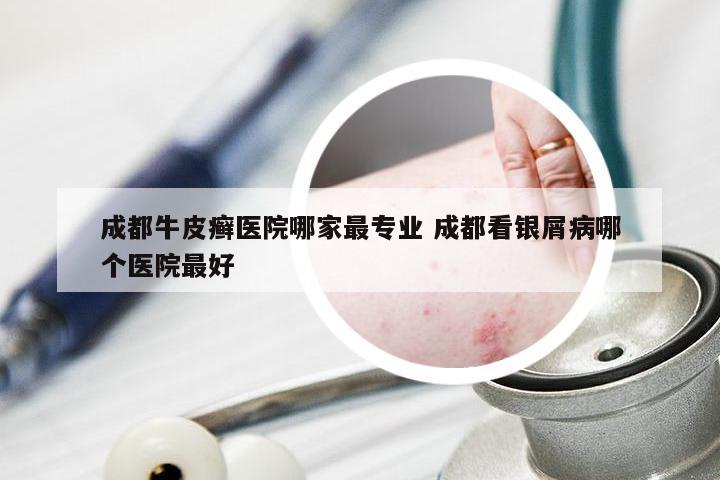 成都牛皮癣医院哪家最专业 成都看银屑病哪个医院最好