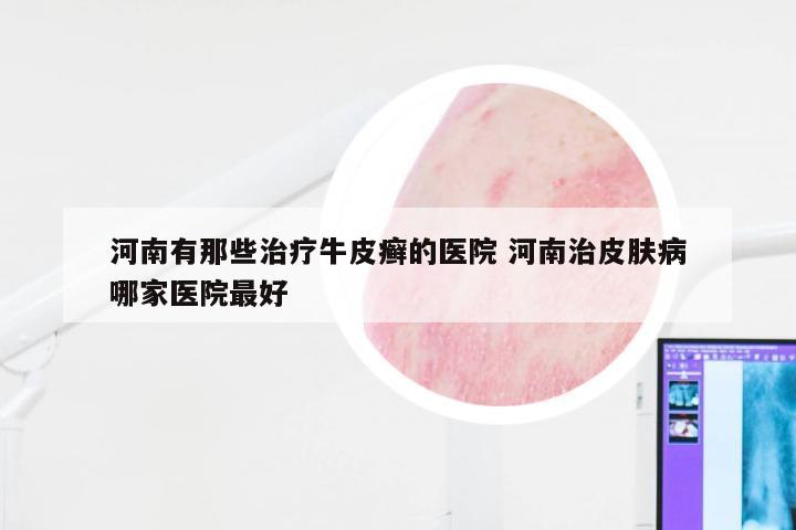 河南有那些治疗牛皮癣的医院 河南治皮肤病哪家医院最好