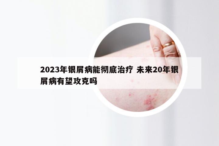 2023年银屑病能彻底治疗 未来20年银屑病有望攻克吗