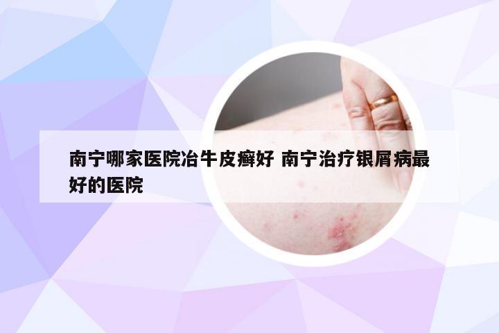 南宁哪家医院冶牛皮癣好 南宁治疗银屑病最好的医院