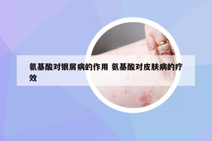 氨基酸对银屑病的作用 氨基酸对皮肤病的疗效