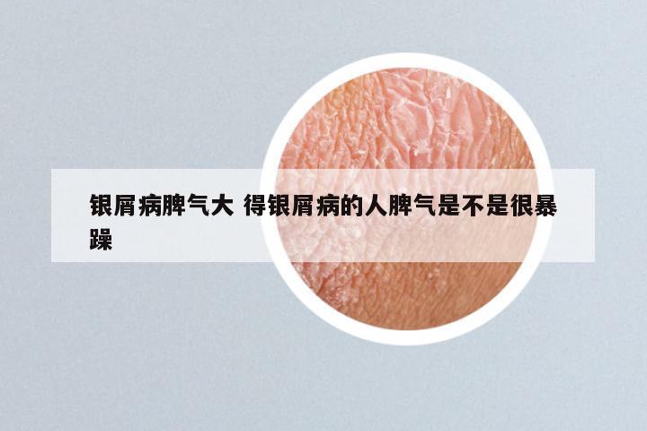 银屑病脾气大 得银屑病的人脾气是不是很暴躁