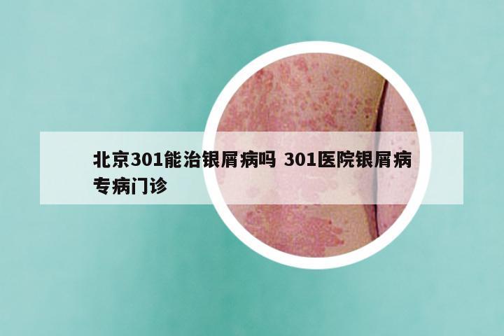 北京301能治银屑病吗 301医院银屑病专病门诊