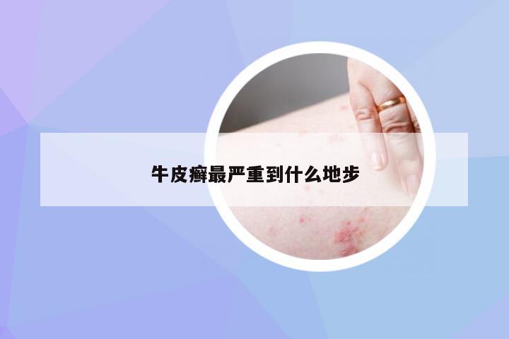 牛皮癣最严重到什么地步