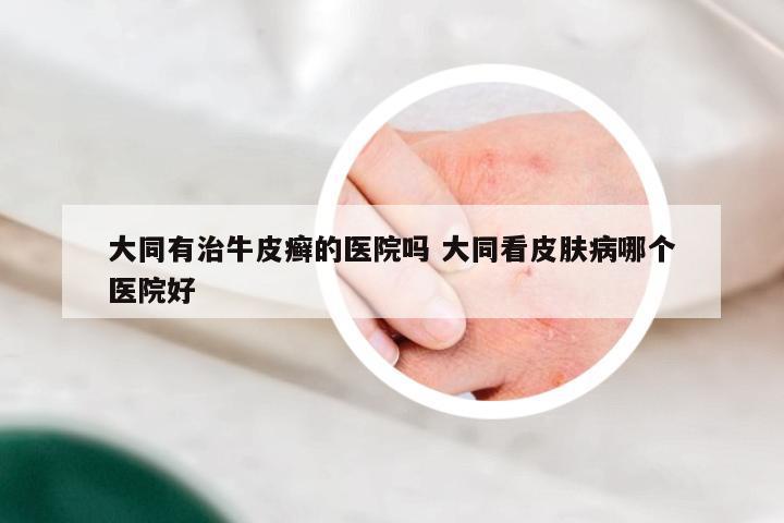 大同有治牛皮癣的医院吗 大同看皮肤病哪个医院好