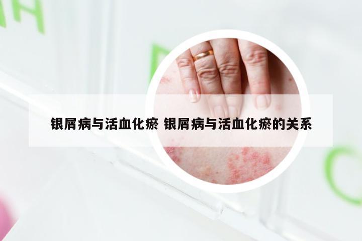 银屑病与活血化瘀 银屑病与活血化瘀的关系