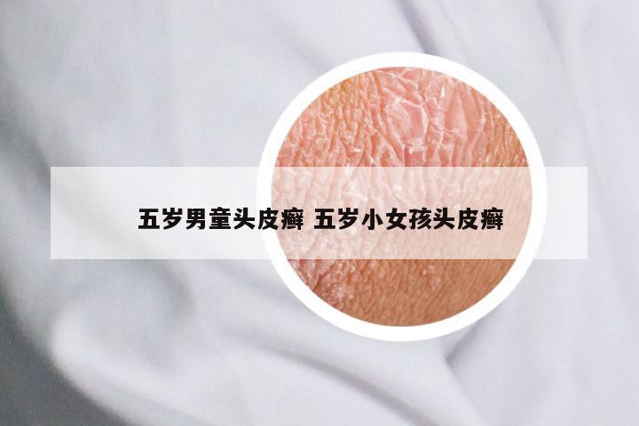 五岁男童头皮癣 五岁小女孩头皮癣
