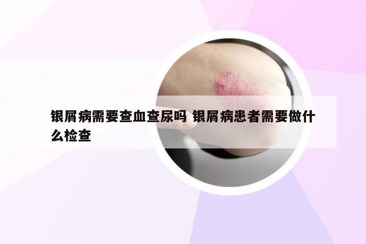 银屑病需要查血查尿吗 银屑病患者需要做什么检查