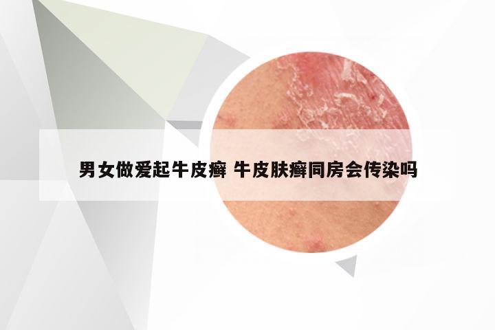 男女做爱起牛皮癣 牛皮肤癣同房会传染吗
