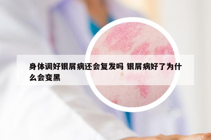身体调好银屑病还会复发吗 银屑病好了为什么会变黑