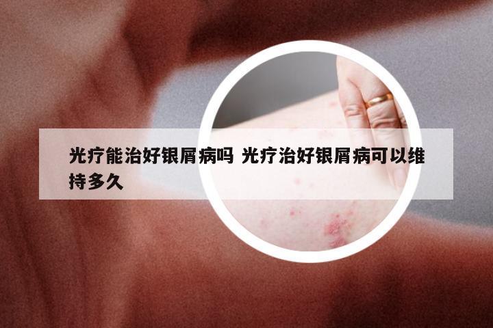 光疗能治好银屑病吗 光疗治好银屑病可以维持多久