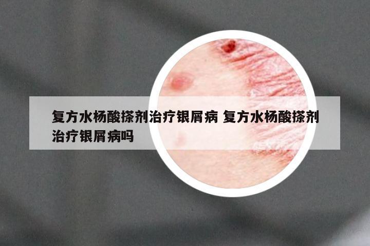 复方水杨酸搽剂治疗银屑病 复方水杨酸搽剂治疗银屑病吗