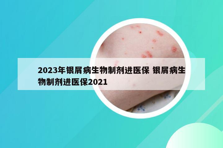 2023年银屑病生物制剂进医保 银屑病生物制剂进医保2021