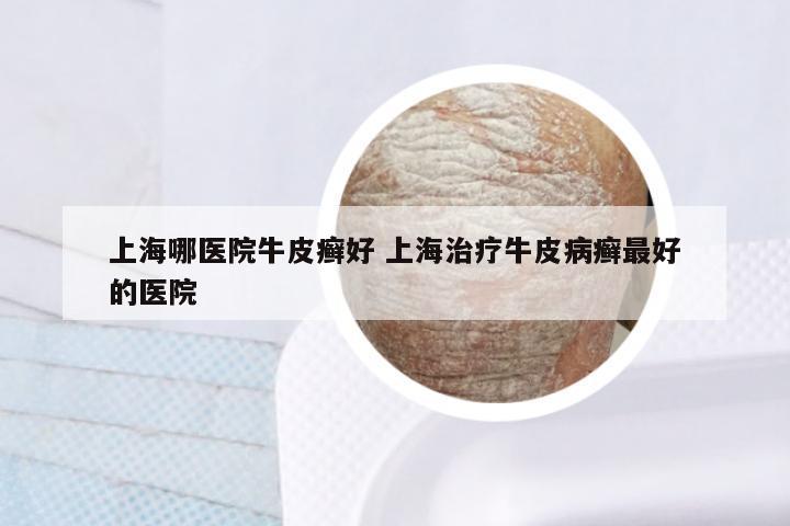 上海哪医院牛皮癣好 上海治疗牛皮病癣最好的医院