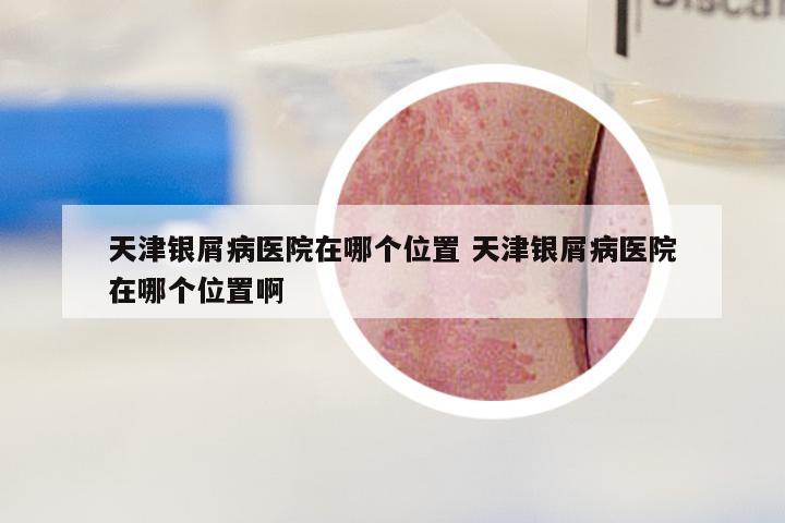 天津银屑病医院在哪个位置 天津银屑病医院在哪个位置啊