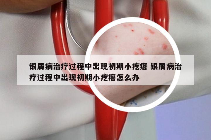 银屑病治疗过程中出现初期小疙瘩 银屑病治疗过程中出现初期小疙瘩怎么办
