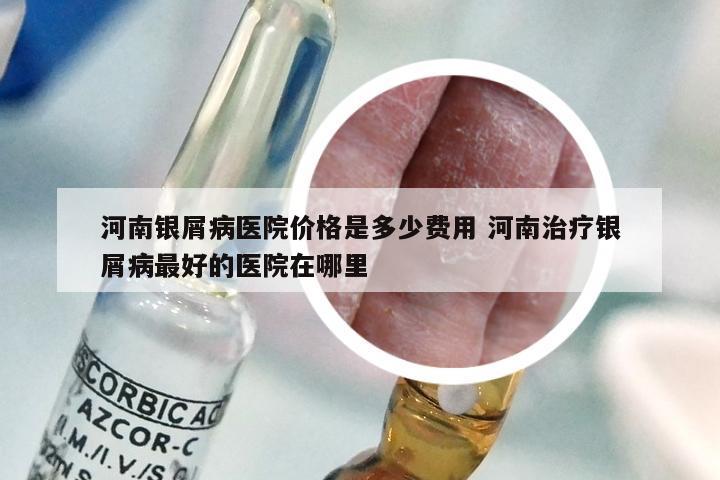 河南银屑病医院价格是多少费用 河南治疗银屑病最好的医院在哪里