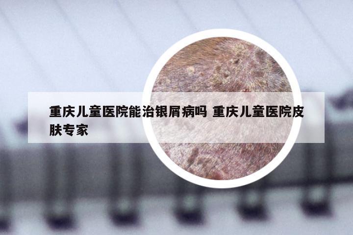 重庆儿童医院能治银屑病吗 重庆儿童医院皮肤专家