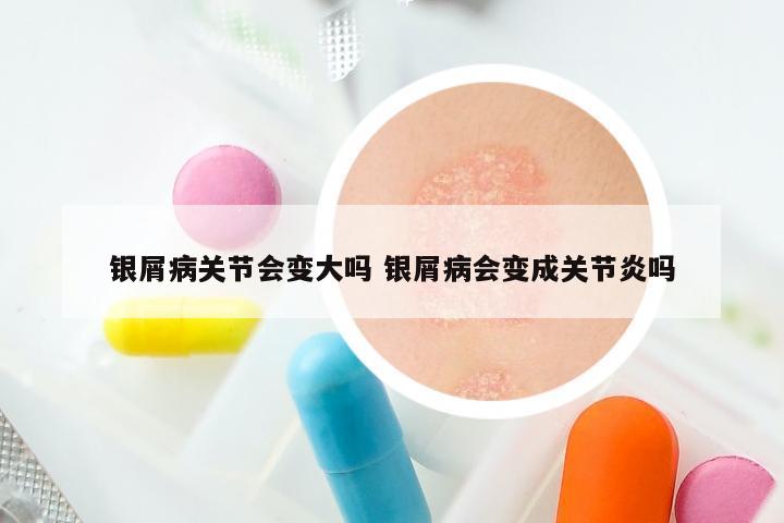 银屑病关节会变大吗 银屑病会变成关节炎吗