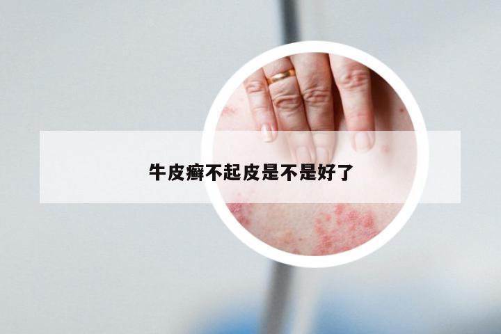 牛皮癣不起皮是不是好了