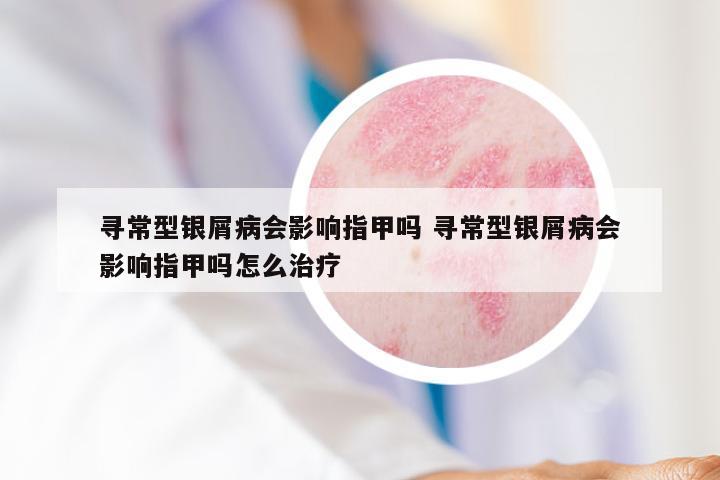 寻常型银屑病会影响指甲吗 寻常型银屑病会影响指甲吗怎么治疗