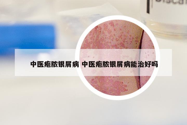 中医疱脓银屑病 中医疱脓银屑病能治好吗