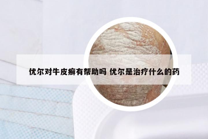 优尔对牛皮癣有帮助吗 优尔是治疗什么的药