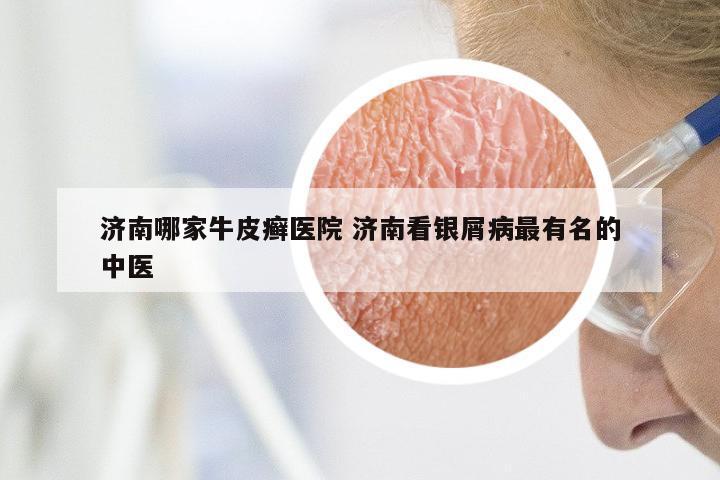 济南哪家牛皮癣医院 济南看银屑病最有名的中医