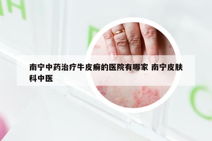 南宁中药治疗牛皮癣的医院有哪家 南宁皮肤科中医
