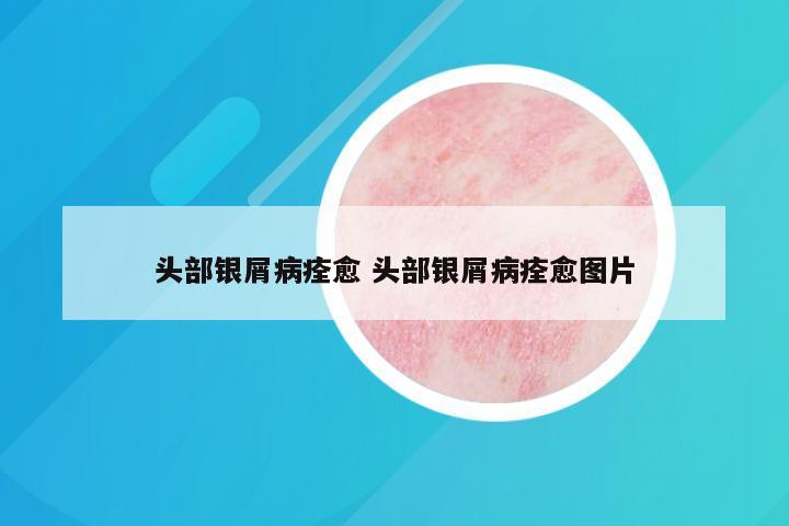 头部银屑病痊愈 头部银屑病痊愈图片