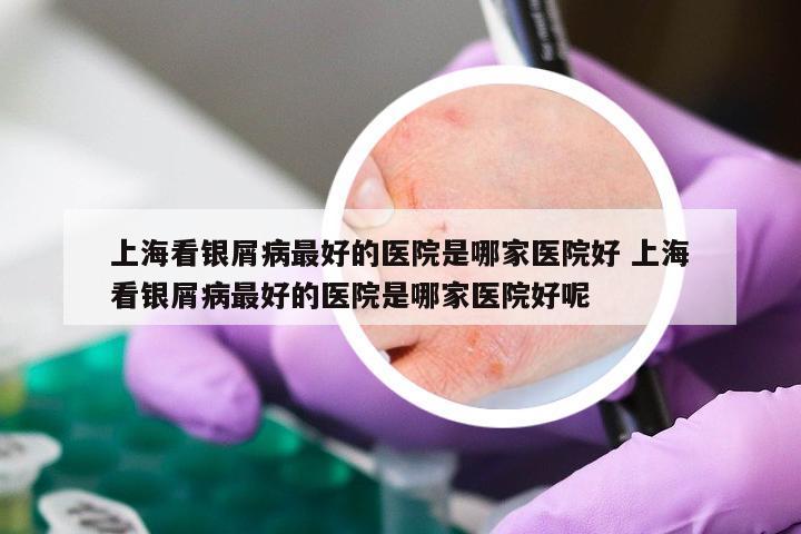 上海看银屑病最好的医院是哪家医院好 上海看银屑病最好的医院是哪家医院好呢