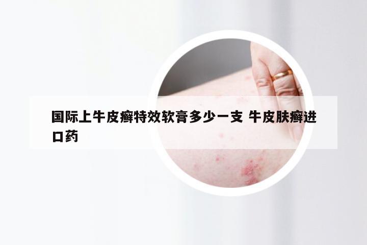 国际上牛皮癣特效软膏多少一支 牛皮肤癣进口药