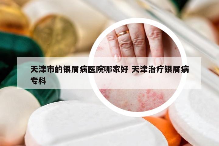 天津市的银屑病医院哪家好 天津治疗银屑病专科