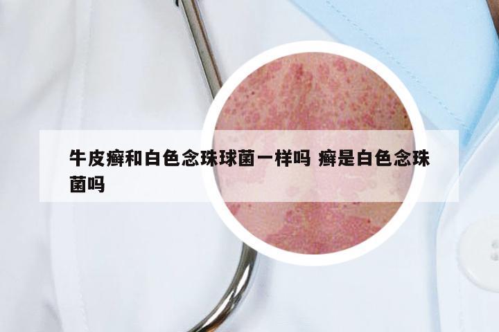 牛皮癣和白色念珠球菌一样吗 癣是白色念珠菌吗