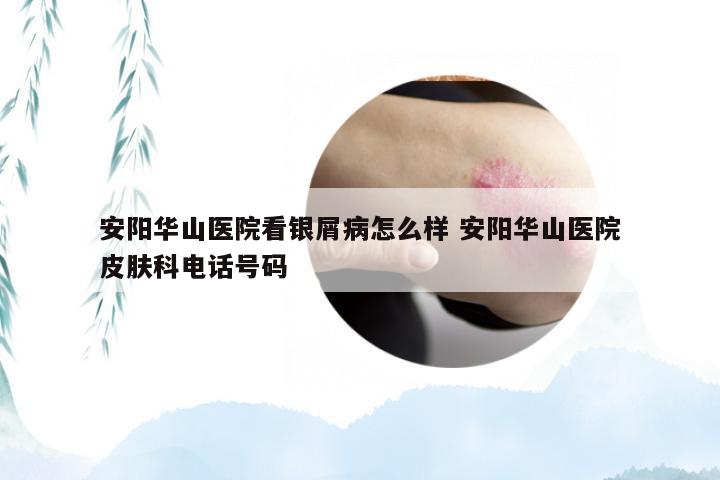 安阳华山医院看银屑病怎么样 安阳华山医院皮肤科电话号码